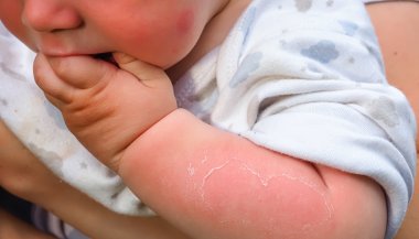 Mano, Bambino, Neonato, Pelle, Primo piano, Scottatura solare, Esfoliazione, Della Mano, Bambino, Neonato, Pelle, Primo piano, Scottatura solare, Esfoliazione, Della